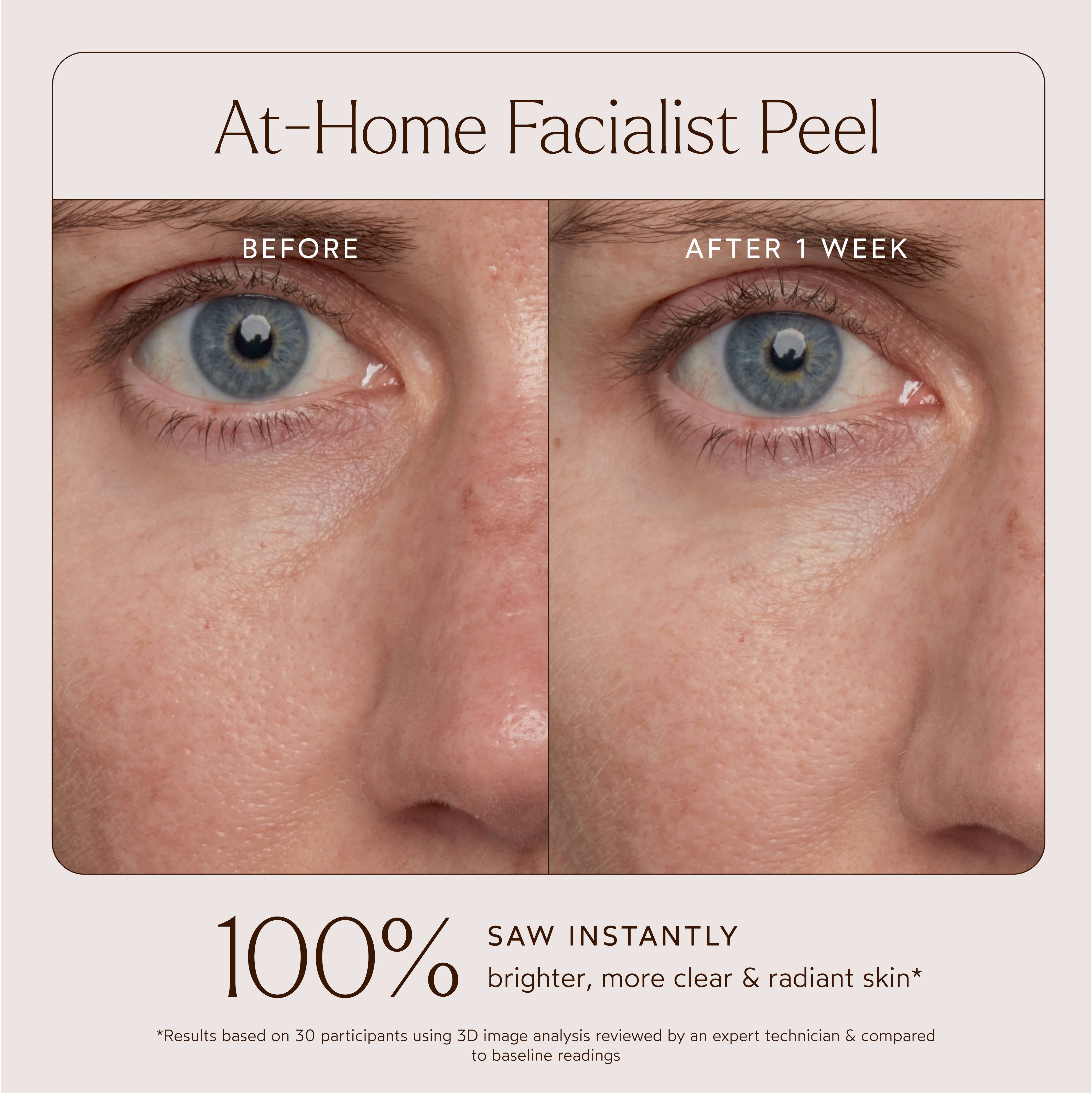 At-Home Facial Peel Treatment: Full Size (1.01 fl oz | 30 ml)