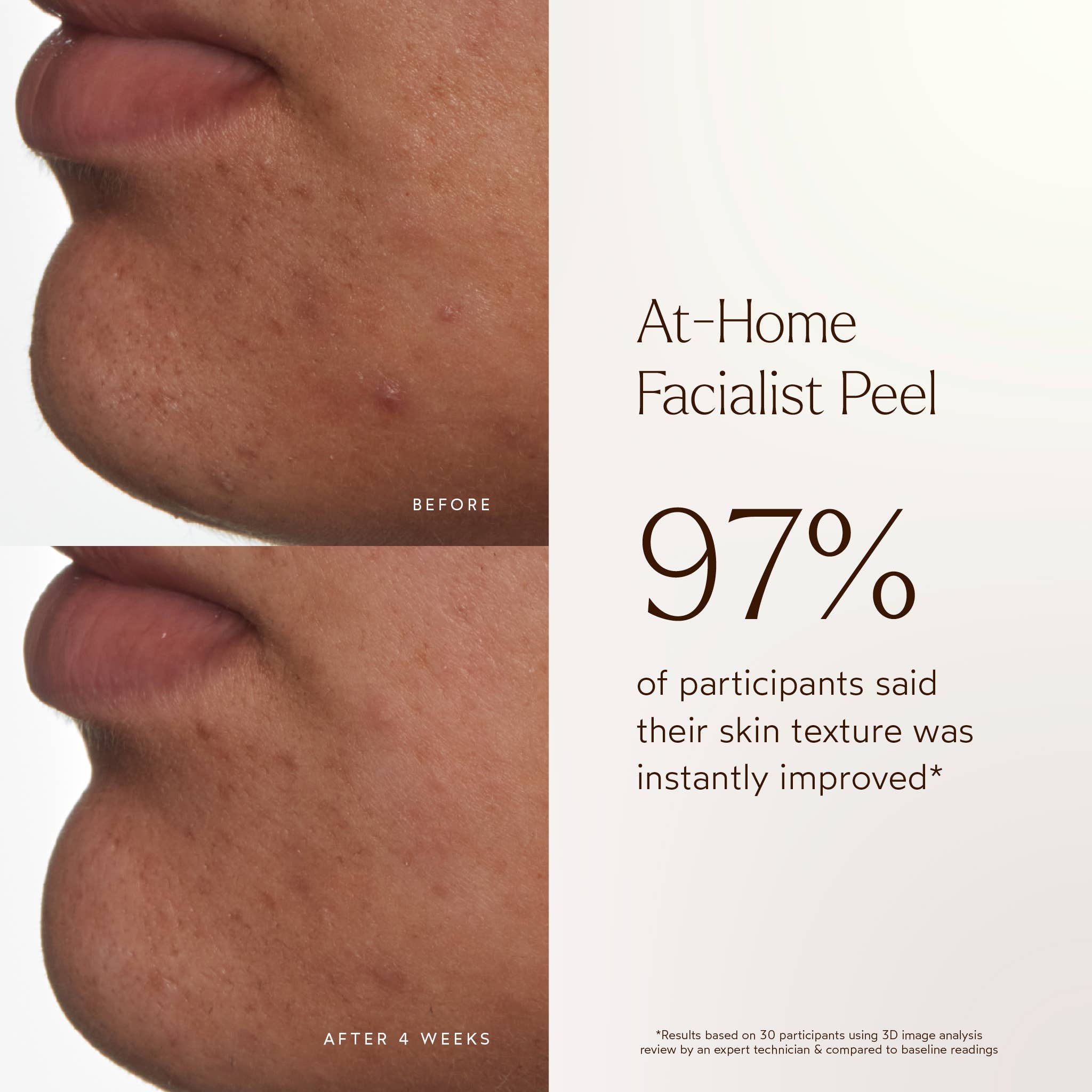 At-Home Facial Peel Treatment: Full Size (1.01 fl oz | 30 ml)